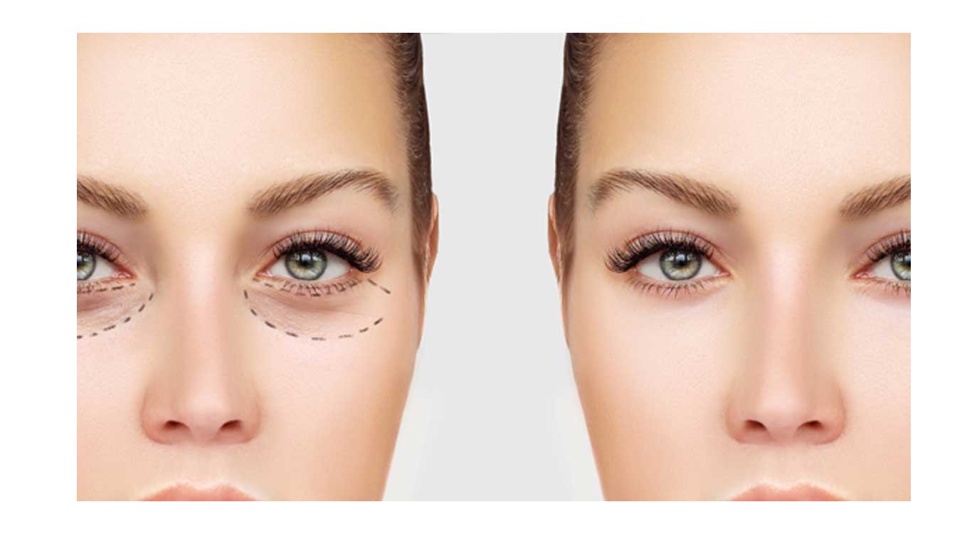 Eyelid-surgery-to-rejuvenate-the-eyes-and-correct-functional-problems